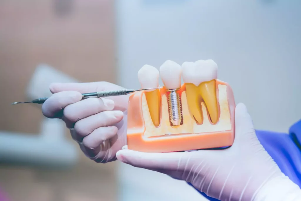 pic 2dental implant 64e1b16b486fd